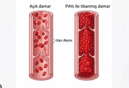 Akut Derin Ven Trombozu