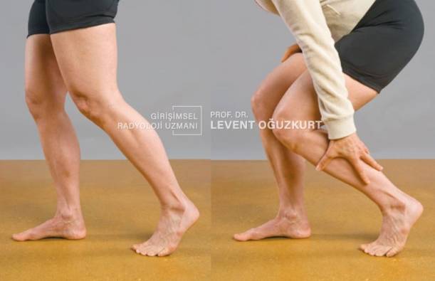 Bacak Damar Tıkanıklığı | Prof. Dr. Levent OĞUZKURT