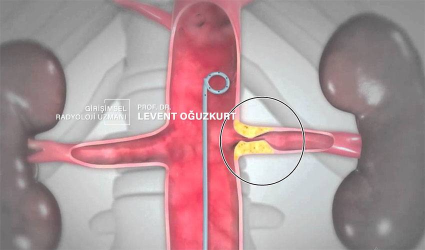 REnal arter stent tedavisi