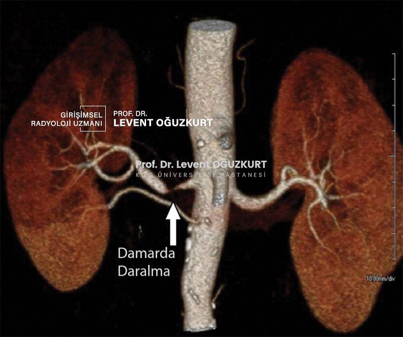 Böbrek damar tıkanması renal arter stenozu