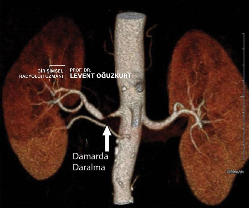 Böbrek damar tıkanması renal arter stenozu