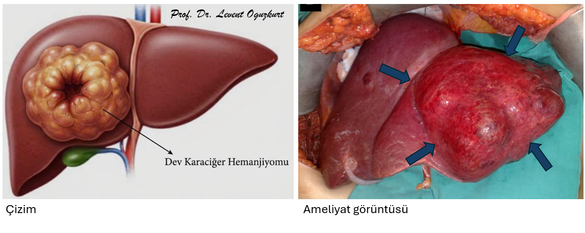 Karaciğerde dev hemanjiyom