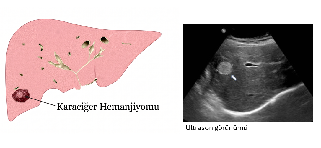 Karaciğerde hemanjiyom