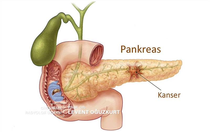 pankreass tümörüne iğne biyopsisi