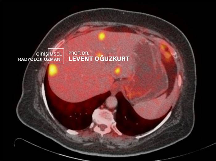 PET tomografide karaciğerde yerleşen kanser odakları