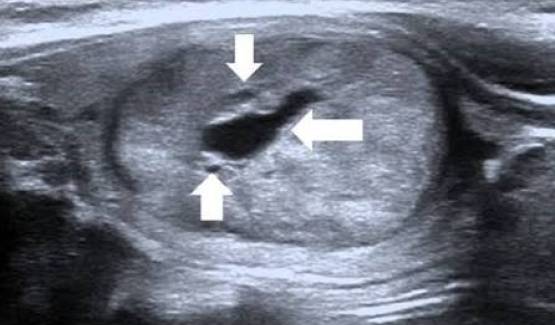 Tiroid nodülü ablasyonu